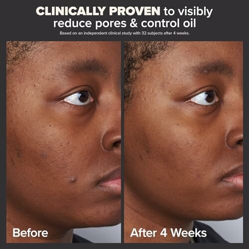 Before and after comparison of skincare results on reducing pores and controlling oil.